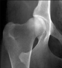 Articulation  coxo femorale