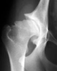 Arthrose